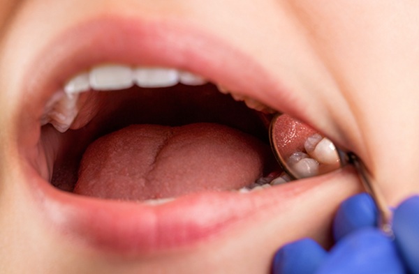 Is Tooth Extraction Necessary Before Receiving Dental Implants?